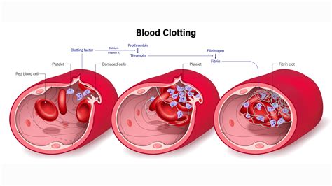 Excessive Clotting .